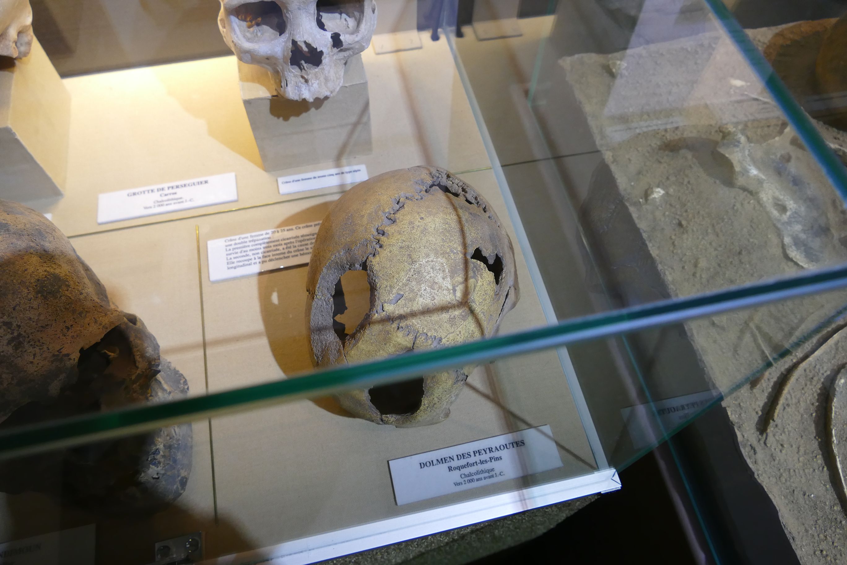 2021 Trepanation